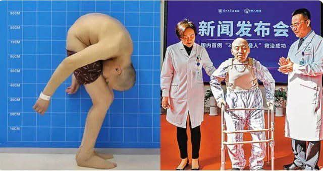 Chinese man, Li Hua, more commonly know as the “folded man”, finally stands up straight after 28 years of suffering from ankylosing spondylitis. All thanks to a life-changing surgery.